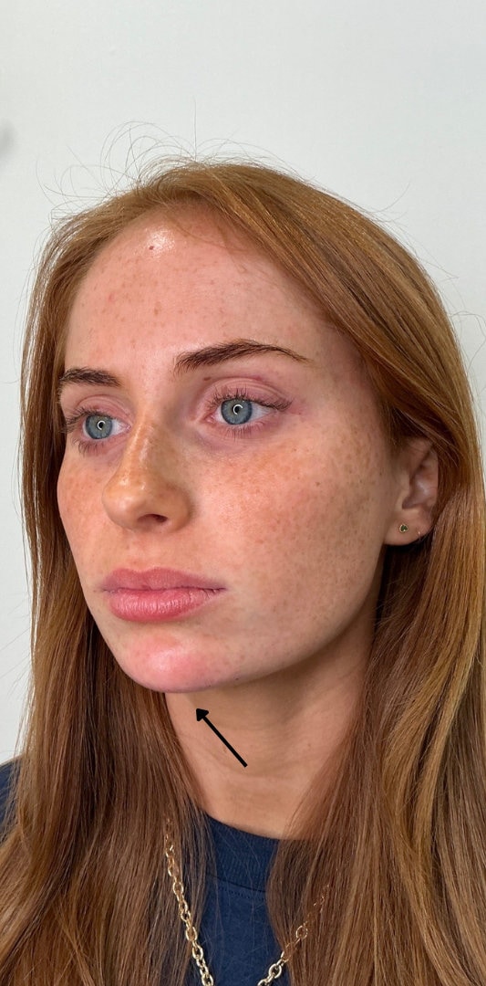 Chin Fillers Before & After Image