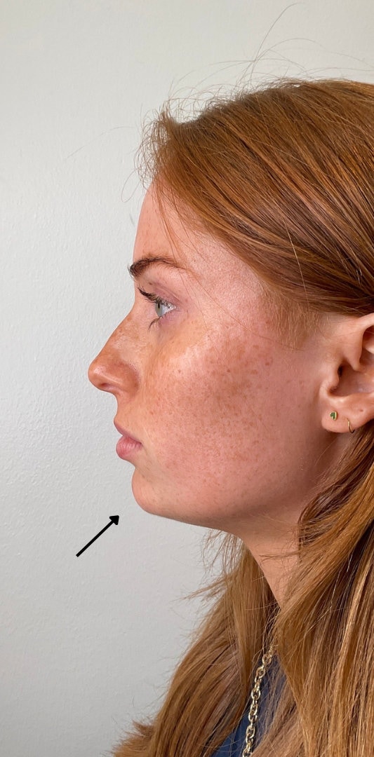 Chin Fillers Before & After Image
