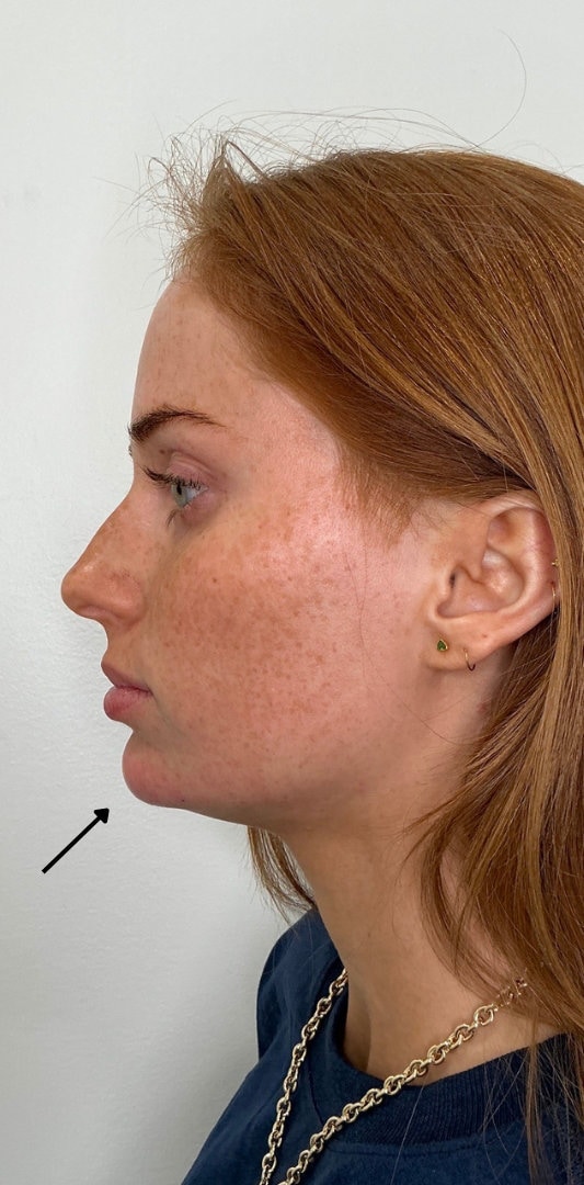 Chin Fillers Before & After Image