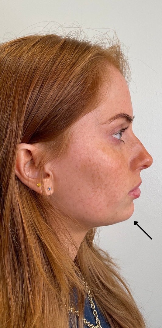 Chin Fillers Before & After Image
