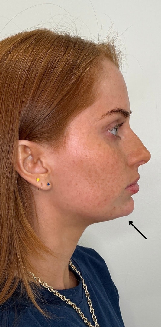 Chin Fillers Before & After Image