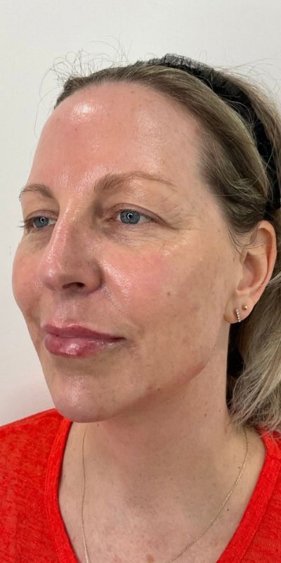 Combined Enhancement Injections Before & After Image