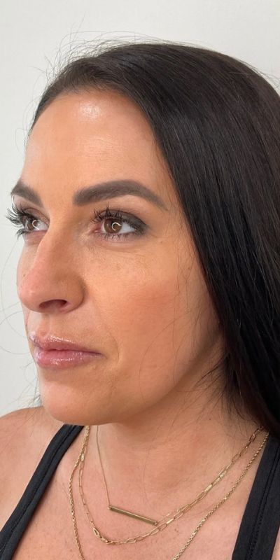 Combined Enhancement Injections Before & After Image
