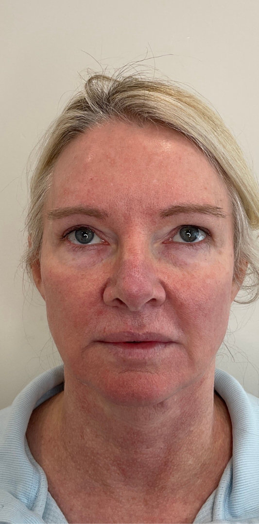 Combined Enhancement Injections Before & After Image