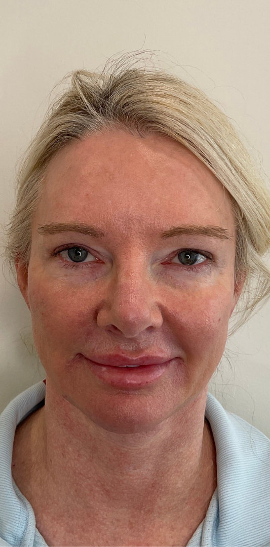 Combined Enhancement Injections Before & After Image