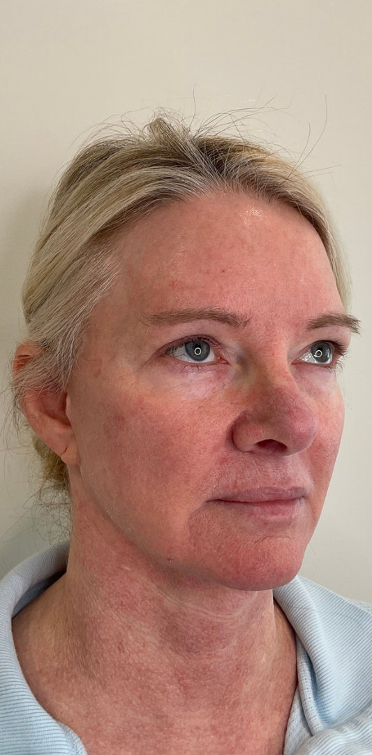 Combined Enhancement Injections Before & After Image