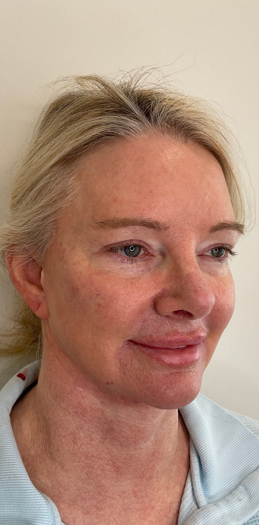 Combined Enhancement Injections Before & After Image
