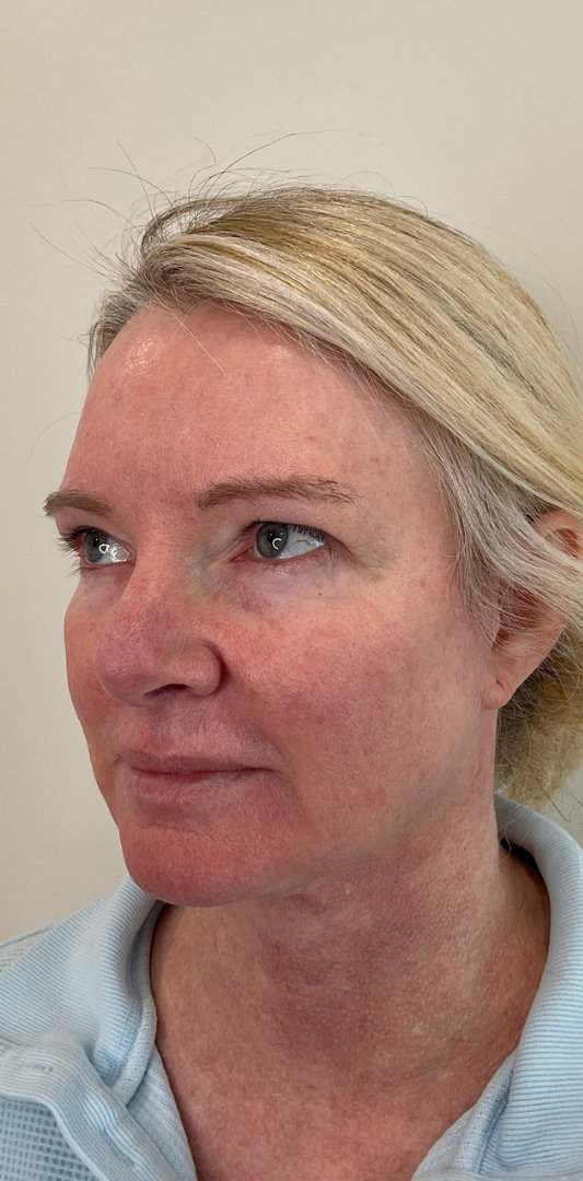 Combined Enhancement Injections Before & After Image