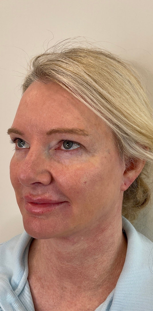 Combined Enhancement Injections Before & After Image