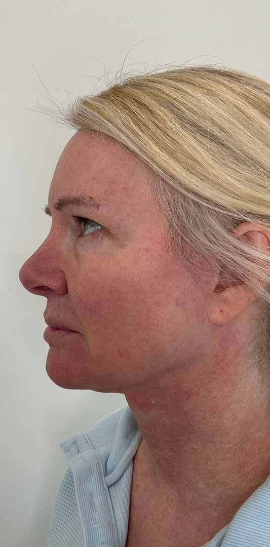 Combined Enhancement Injections Before & After Image