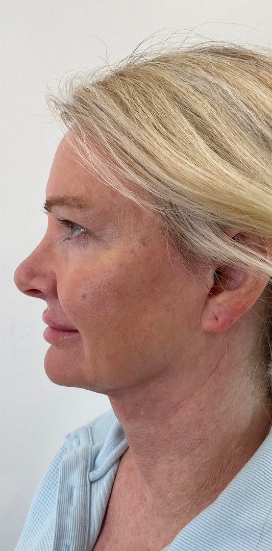 Combined Enhancement Injections Before & After Image