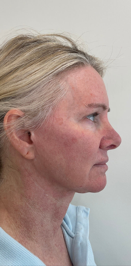Combined Enhancement Injections Before & After Image