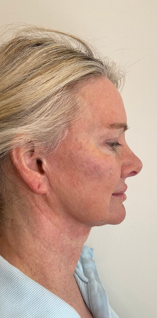 Combined Enhancement Injections Before & After Image