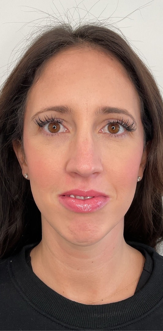 Combined Enhancement Injections Before & After Image
