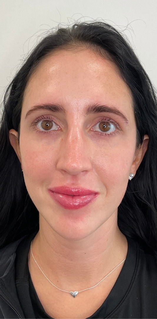 Combined Enhancement Injections Before & After Image