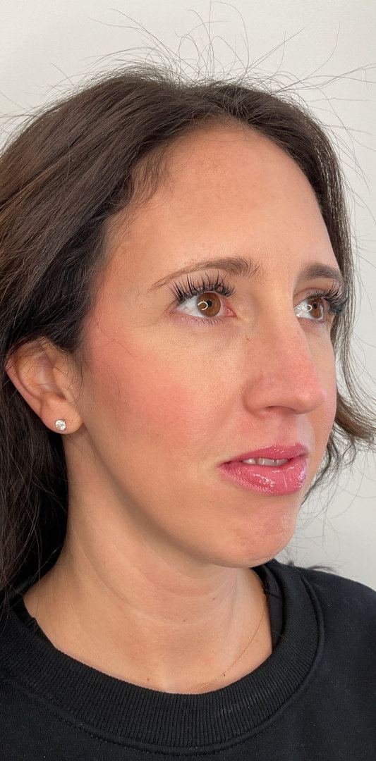 Combined Enhancement Injections Before & After Image