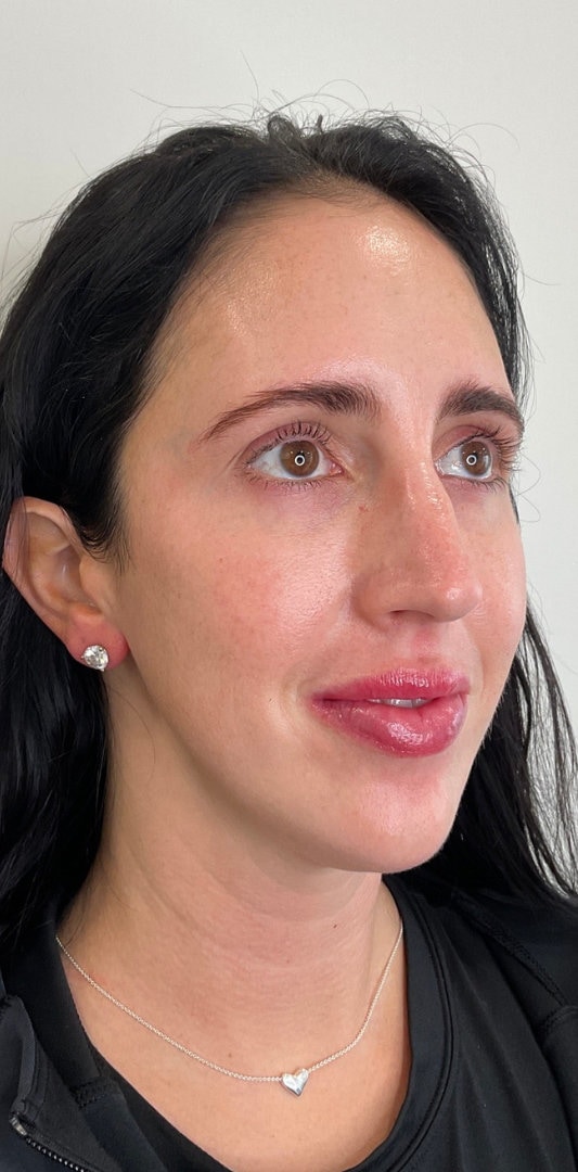 Combined Enhancement Injections Before & After Image