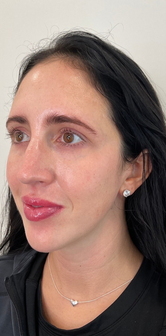 Combined Enhancement Injections Before & After Image