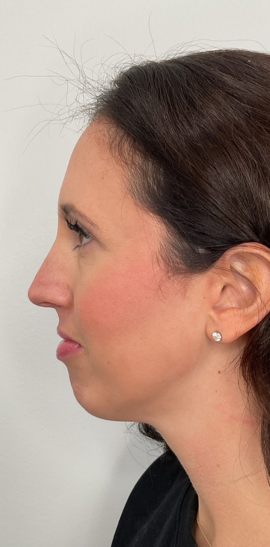 Combined Enhancement Injections Before & After Image