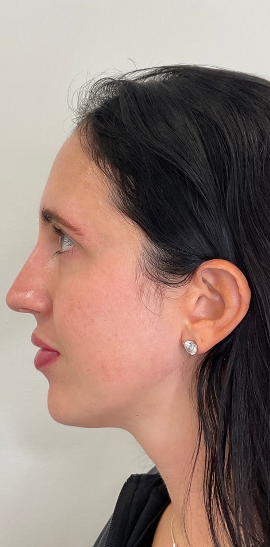 Combined Enhancement Injections Before & After Image