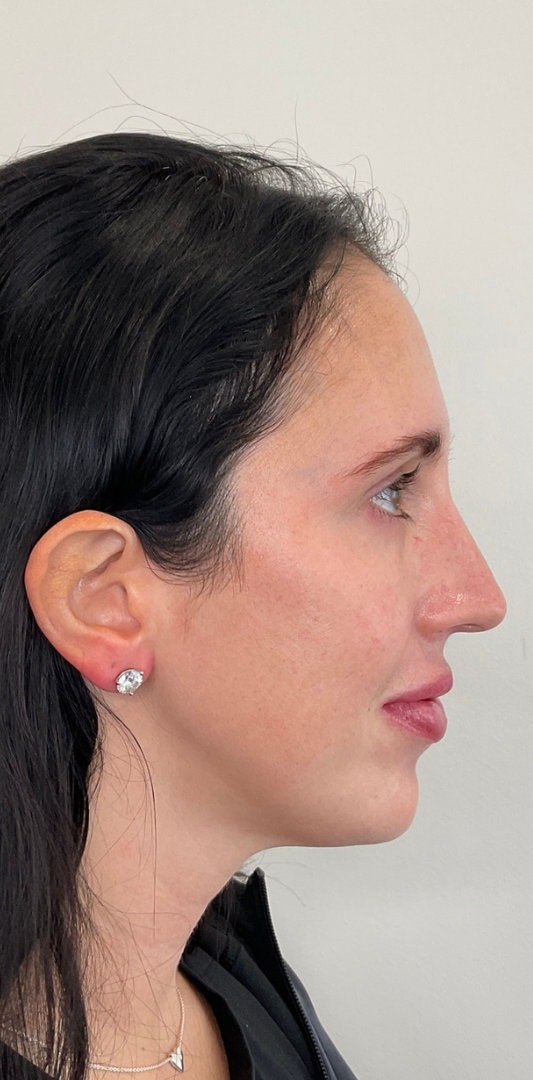 Combined Enhancement Injections Before & After Image