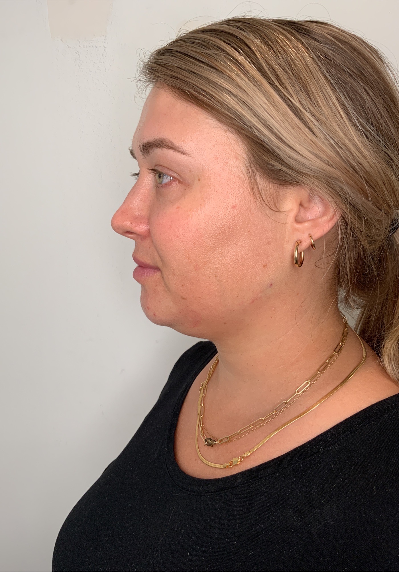 Dermal Fillers Before & After Image