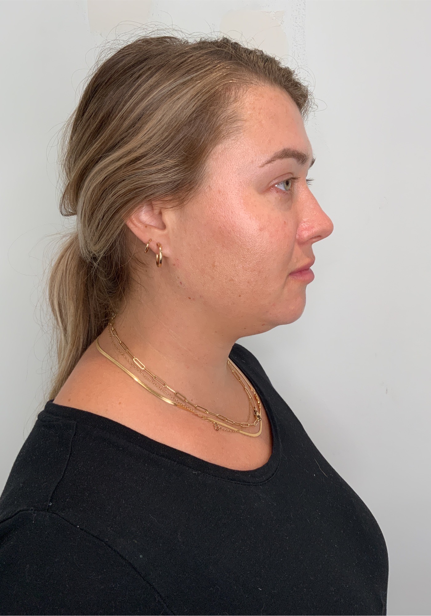 Dermal Fillers Before & After Image