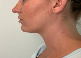 Dermal Fillers Before & After Image