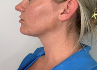 Dermal Fillers Before & After Image