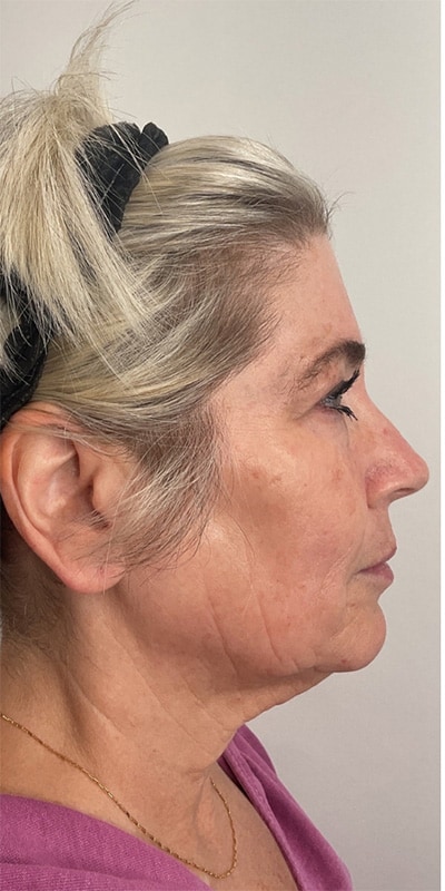 Dermal Fillers Before & After Image