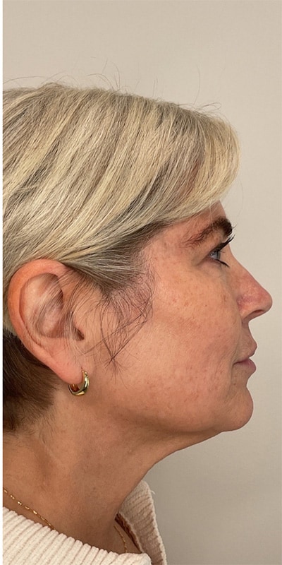 Dermal Fillers Before & After Image