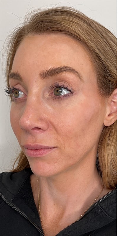 Dermal Fillers Before & After Image