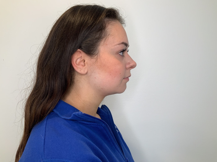 Kybella Before & After Image