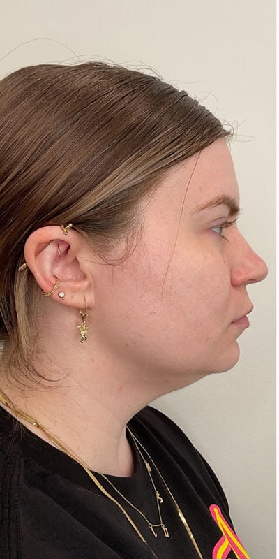 Kybella Before & After Image