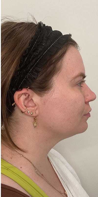 Kybella Before & After Image