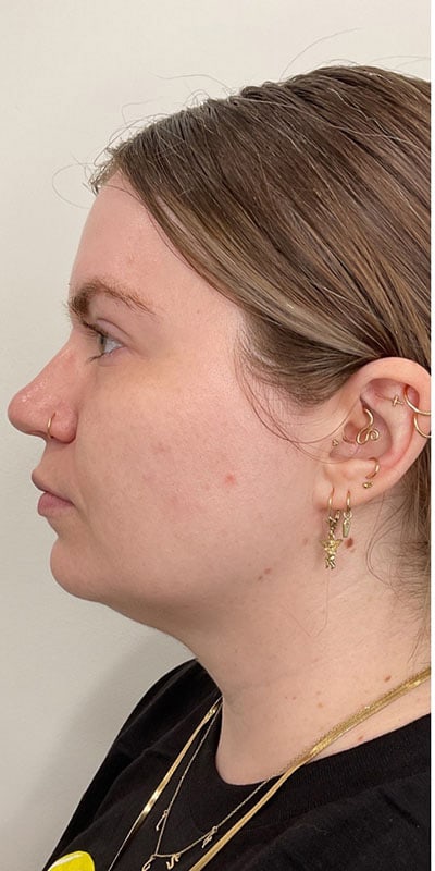 Kybella Before & After Image