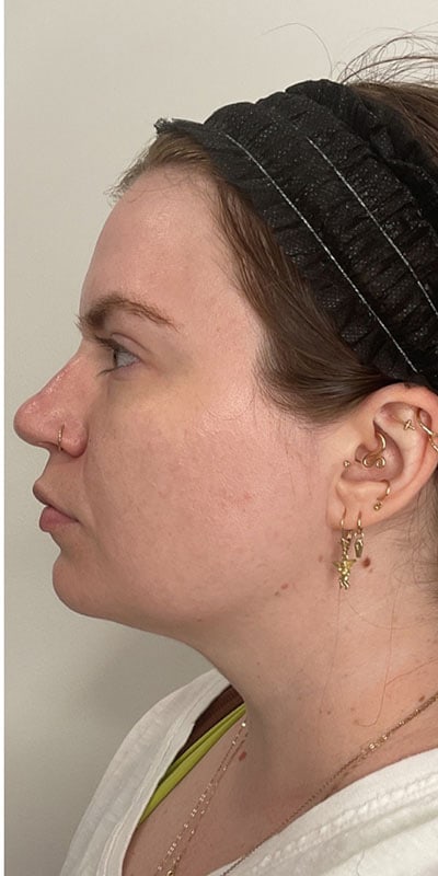 Kybella Before & After Image