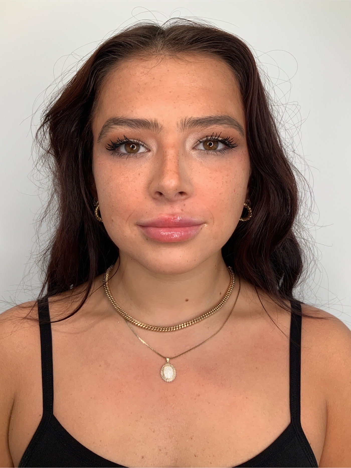 Lip Fillers Before & After Image