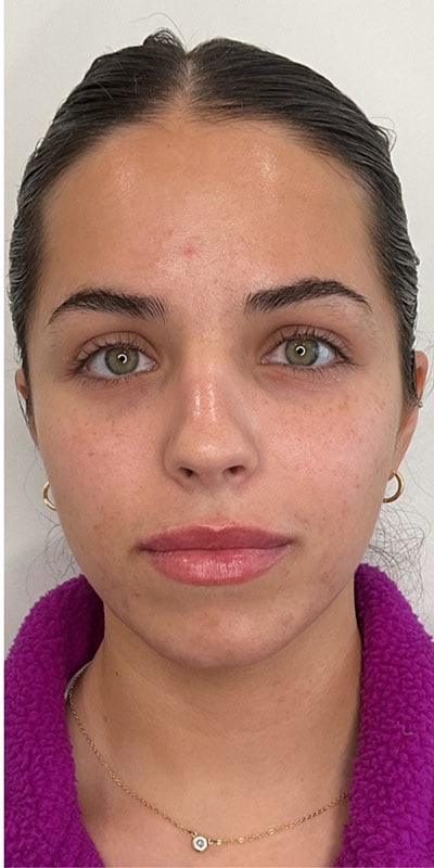 Lip Fillers Before & After Image