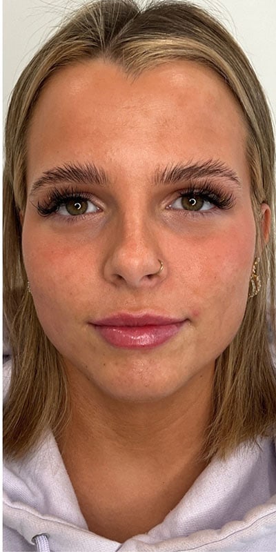 Lip Fillers Before & After Image