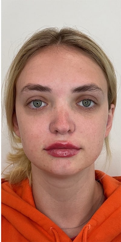 Lip Fillers Before & After Image