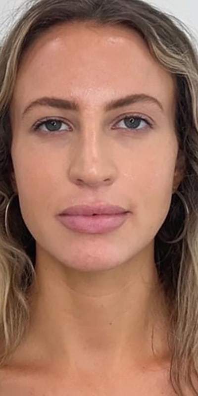 Lip Fillers Before & After Image