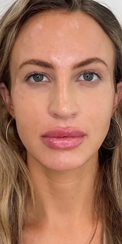 Lip Fillers Before & After Image