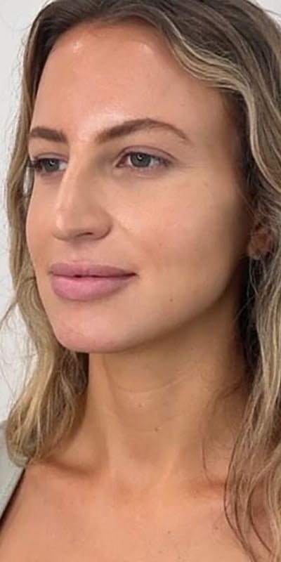 Lip Fillers Before & After Image