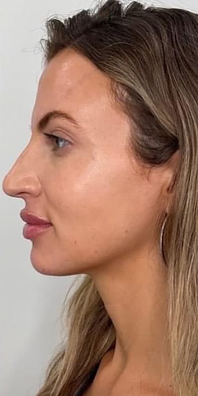 Lip Fillers Before & After Image