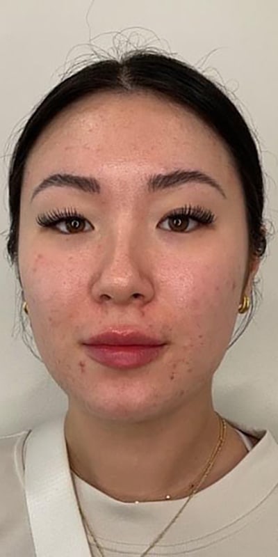 Lip Fillers Before & After Image