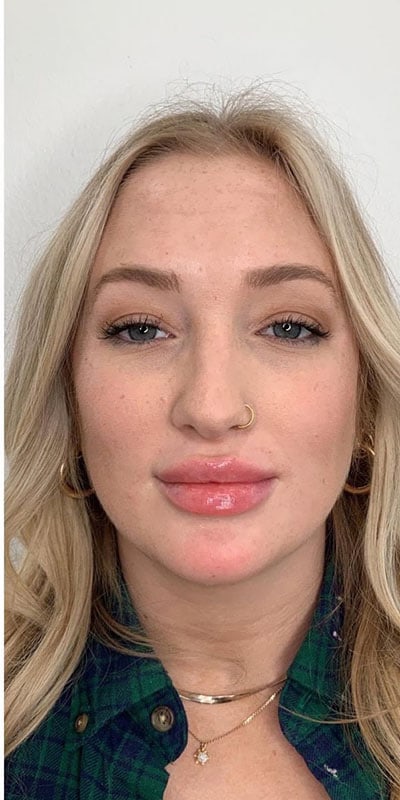 Lip Fillers Before & After Image