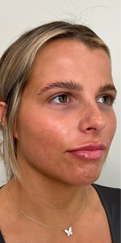 Lip Fillers Before & After Image