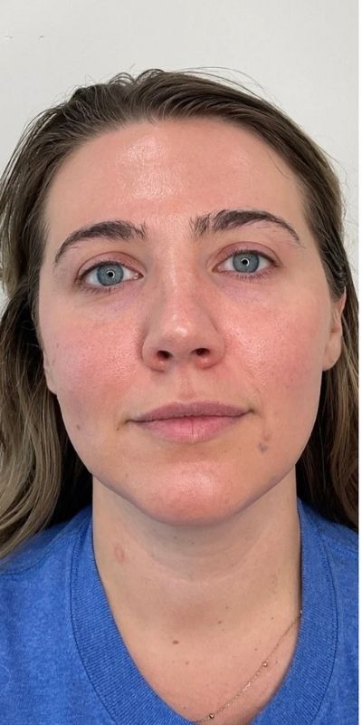 Lip Fillers Before & After Image