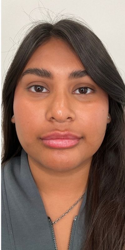 Lip Fillers Before & After Image